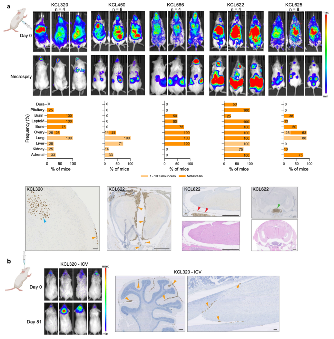 Nature子刊：患者來源的類器官，為乳腺癌腦轉移帶來新見解
